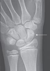 scaphoid törés X-ray kép